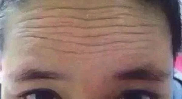 做胶原蛋白去抬头纹手术注意事项是什么？