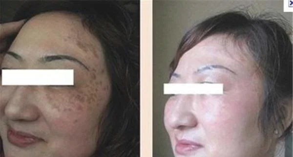 做光子治疗去黄褐斑价格是多少