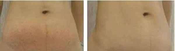 做腹壁整形去妊娠纹治疗效果怎么样？效果保持时间多久？