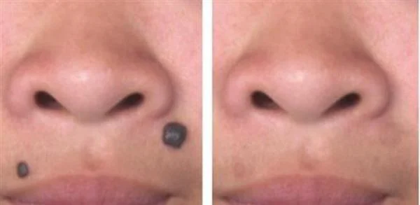 激光祛痣多少钱