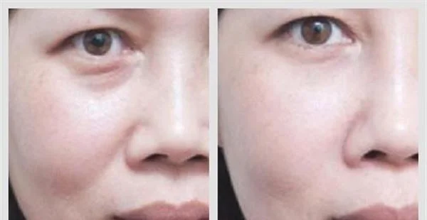 做悬吊除皱去法令纹价格贵不贵