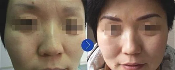 射频微针去眉间纹手术安全吗？