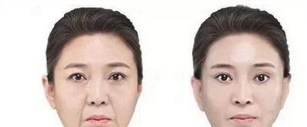做自体脂肪去法令纹多少钱