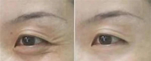 E光去鱼尾纹维持时间是多久？