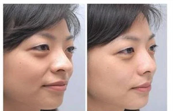 做爱贝芙去法令纹手术多少钱?