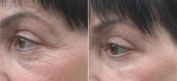 玻尿酸去鱼尾纹手术注意事项是什么?