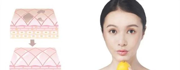 做果酸美白多少钱