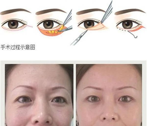 自体脂肪去眼角细纹效果如何?