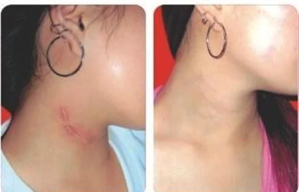 做注射去疤手术多少钱？