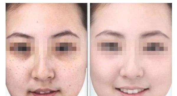 做冷冻法去雀斑治疗效果怎么样？效果保持时间多久？