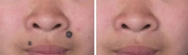 做化学剥脱点痣价格要多少