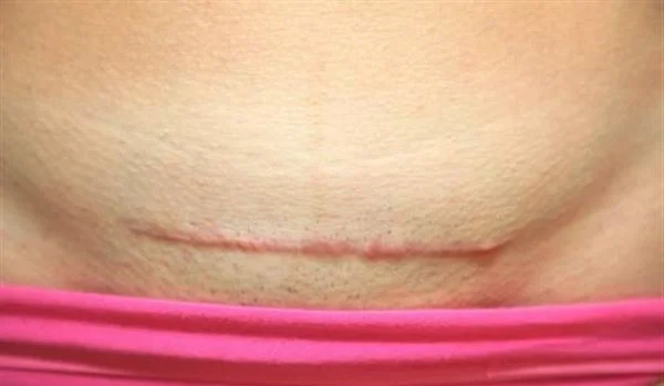 剖腹产疤痕修复手术注意事项是什么?