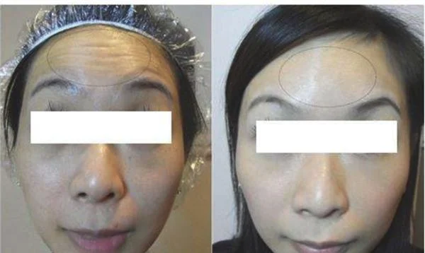 做胶原蛋白去抬头纹治疗效果怎么样？效果保持时间多久？