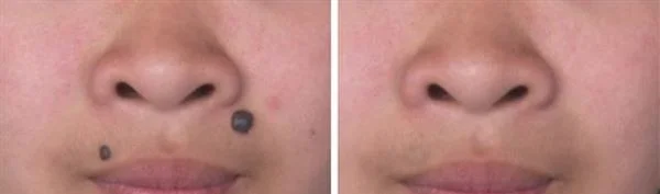 做光子点痣费用大概需要多少