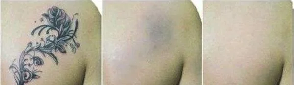 做激光洗纹身治疗效果怎么样？效果保持时间多久？