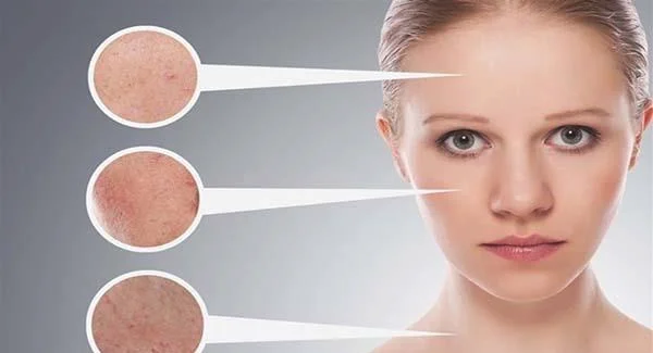 激光祛痘坑价格