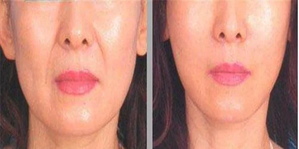 自体脂肪填充鼻唇沟后如何来消肿啊