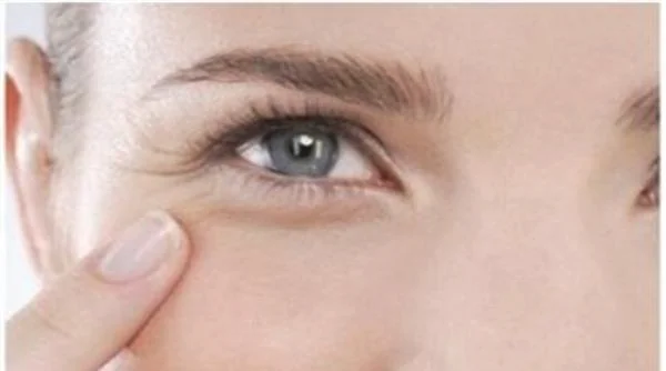 玻尿酸去鱼尾纹的效果咋样啊