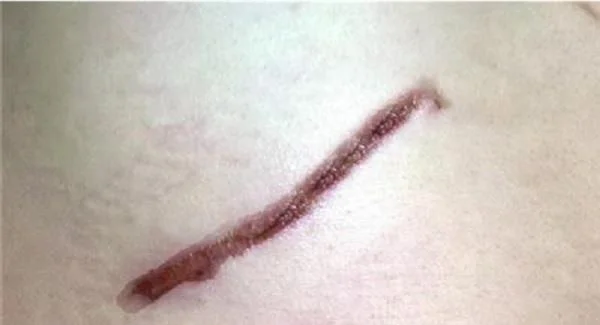 怎样去疤痕快速有效