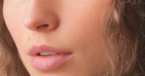 脸上有雀斑是什么皮肤