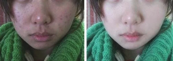 快速祛痘印的简单方法