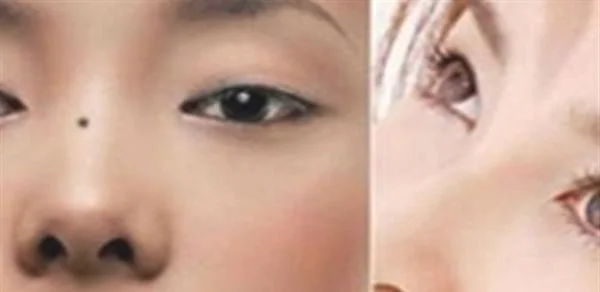 激光去痣有危害吗