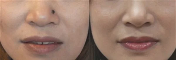 激光去除色素痣价格