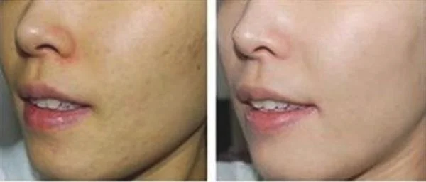 疤痕体质能做光子嫩肤吗