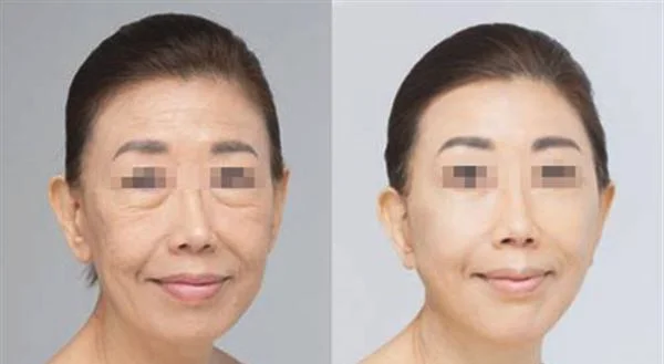 面部提升价格