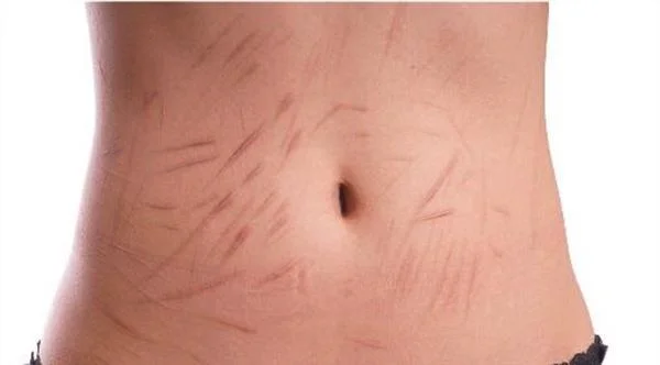 大面积的疤痕应该怎么办