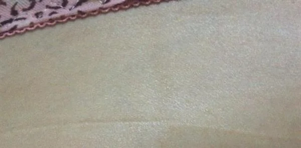 剖腹产祛疤痕修复方法