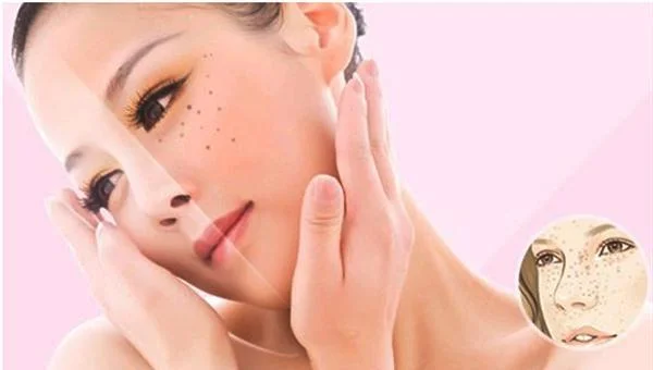 如何祛斑 妊娠斑 晒斑 辐射斑
