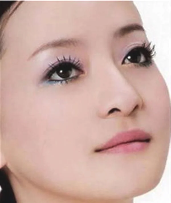 光子嫩肤价格