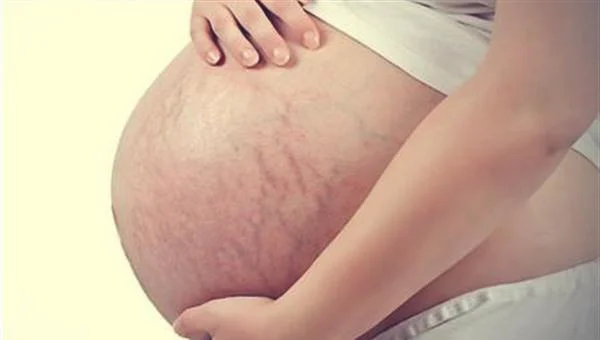 激光可以去妊娠纹吗