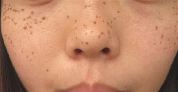 有效祛斑的方法有哪些