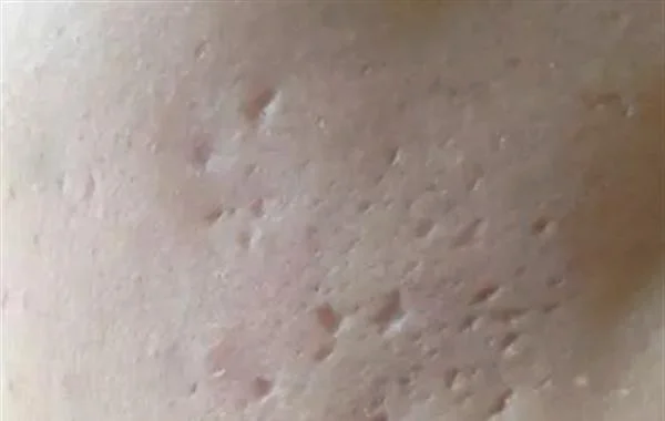 姜可以去疤印吗