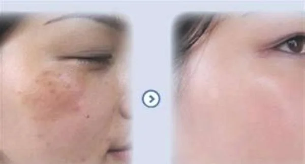 激光去疤痕有效吗