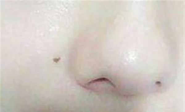 点痣费用是多少