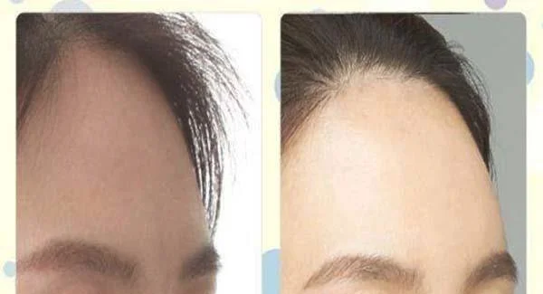 冷冻治疗去痘疤价格