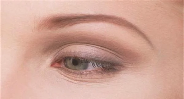 玻尿酸去鱼尾纹的效果怎样