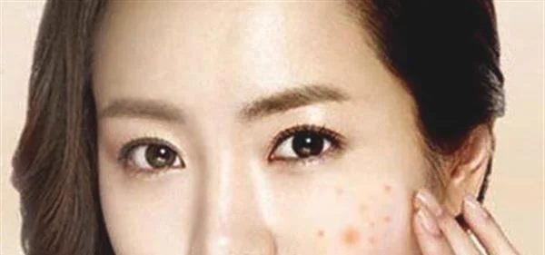 激光去痘印需要多少钱