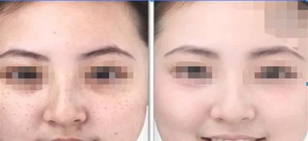 长斑的原因及如何祛斑