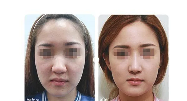 除掉抬头纹要花多少钱