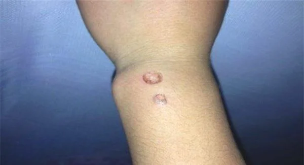 复合彩光疤痕修复手术哪里做的好