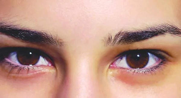 射频微针去眉间纹多少钱