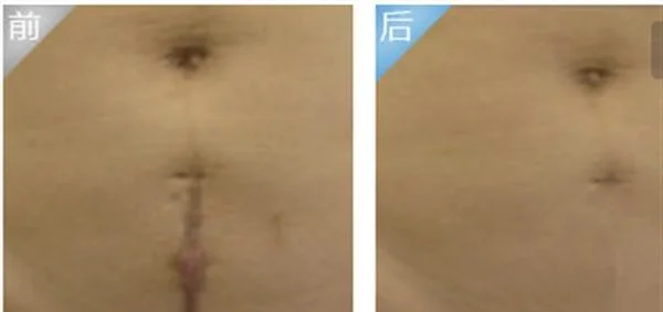 疤痕修复的危害都有哪些