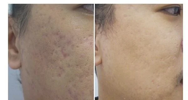 做像素激光一次要花多少钱