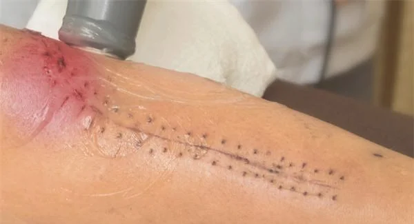 大面积烧伤疤痕能不能修复呢