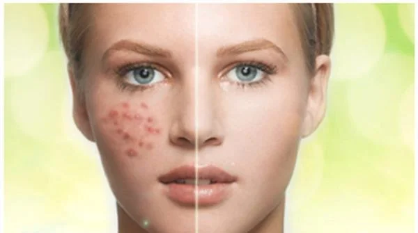 激光法祛痘疤要多少钱