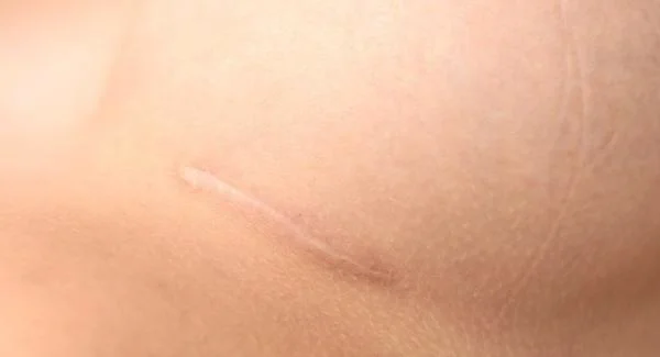 大面积疤痕怎么祛除